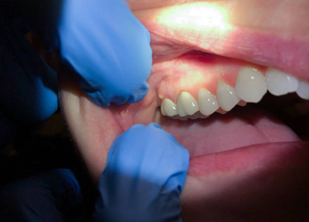 Urgent Tooth Repair in TX